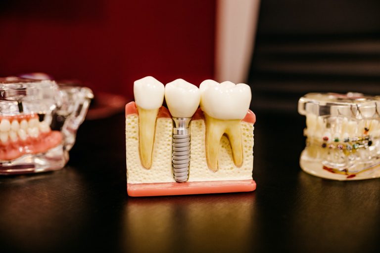 implante dentário