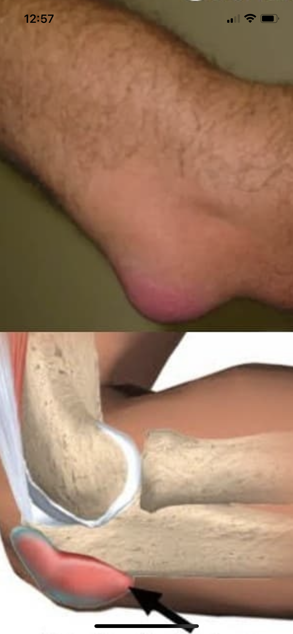 “Bursite de cotovelo: causas, sintomas e tratamento eficaz”